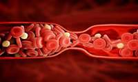 کاهش پلاک‌های خونی ریسک حمله قلبی را تا ۲۵ درصد کاهش می‌دهد 